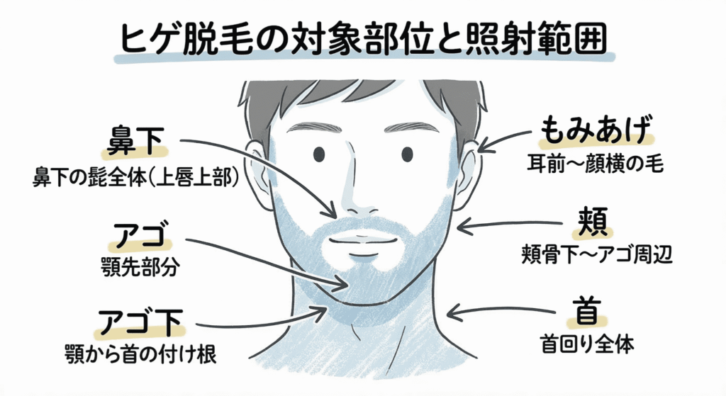 ヒゲ脱毛の対象部位と照射範囲のイラスト